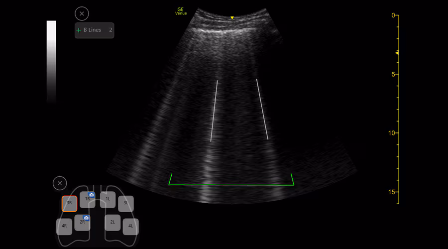 2---blines-with-lung-diagram-r2_900x500