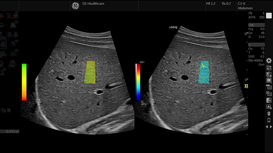 2d-liver-swe-c1-6-d__900x500 (1)