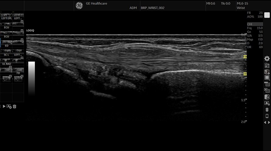 extensortendonofwristbmodeml615rs900x500new (1)
