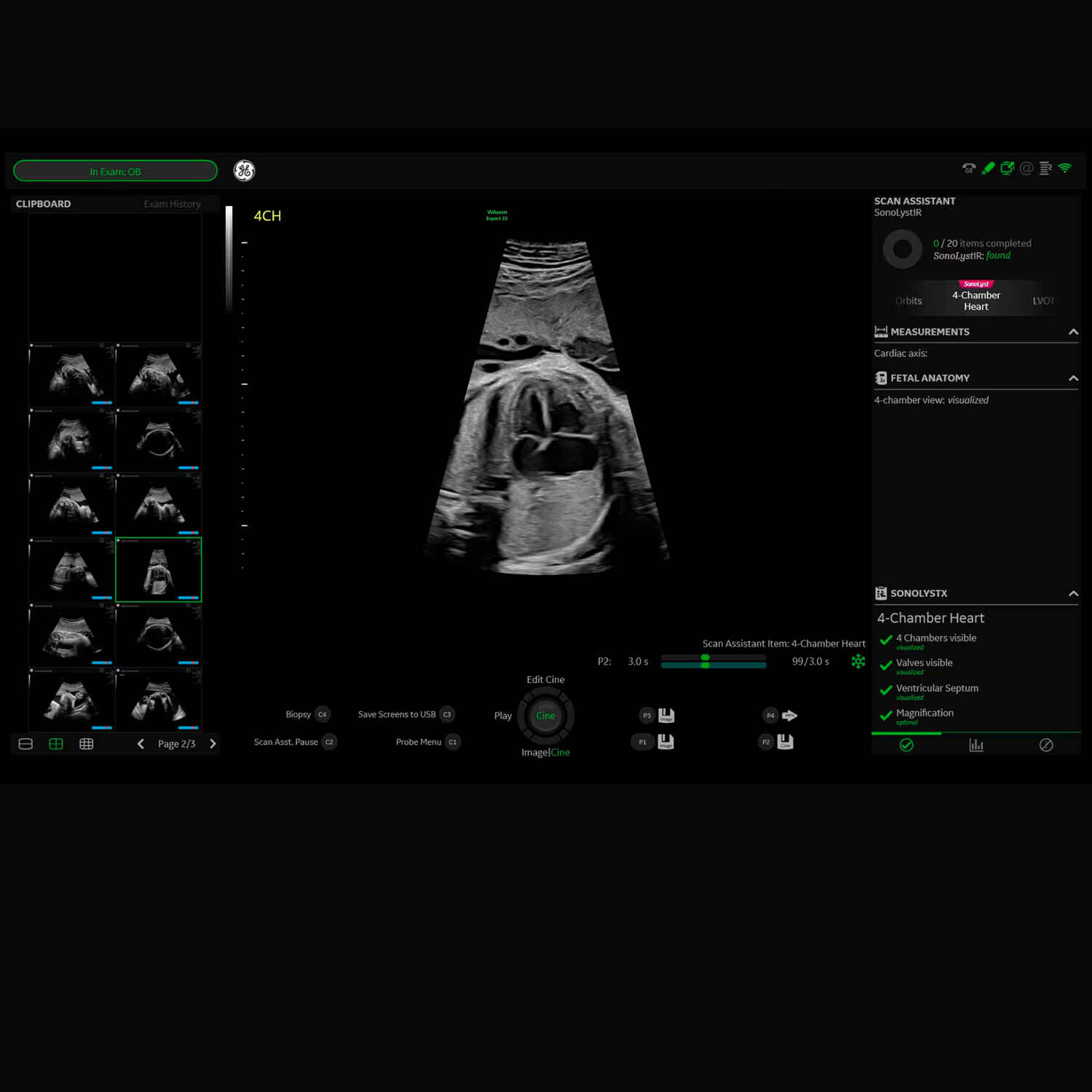 VolusonEXP20-Auto-measure