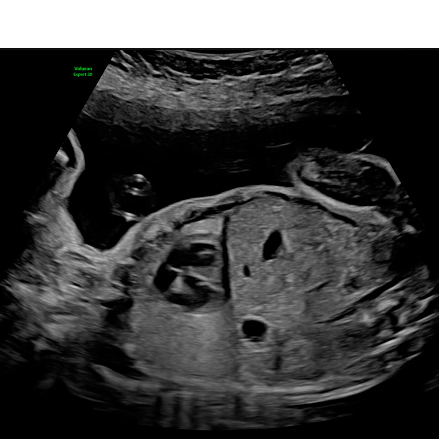 Voluson-Signature-20-Lyric